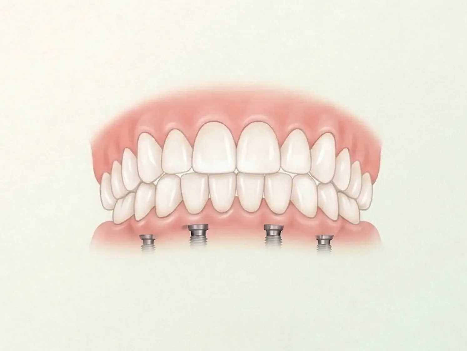 Prótesis All-on-4 sobre implantes dentales
