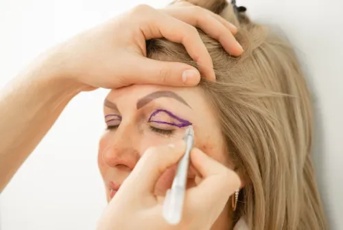 Blepharoplasty - Eyelid Surgery