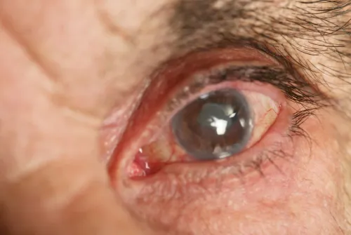 Cataract Surgery - Eye Surgery
