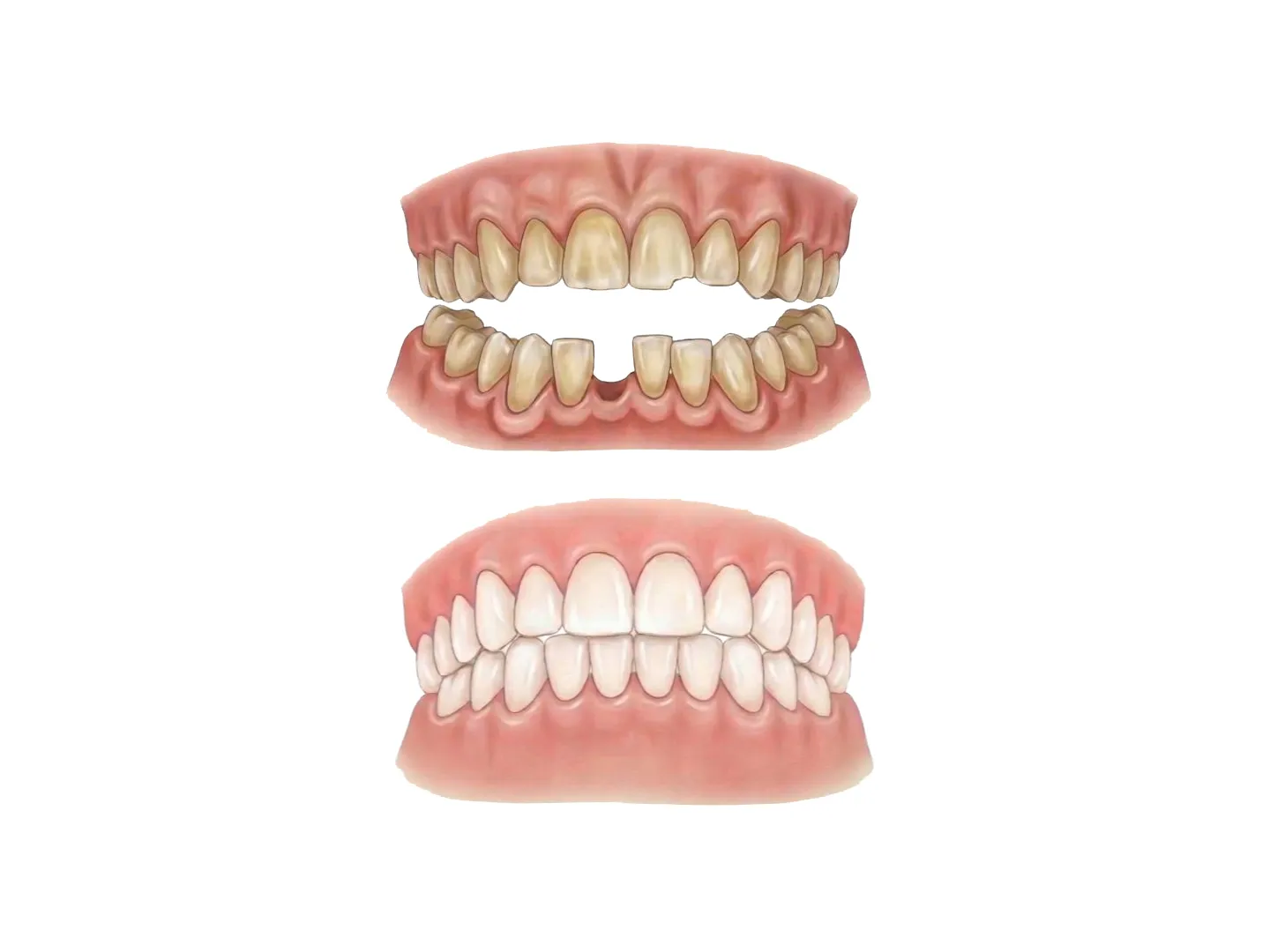 Diseño de sonrisa y rehabilitación a largo plazo