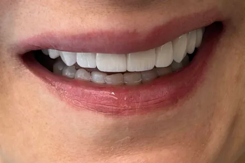 Resultado de diseño de sonrisa en cerámica realizado por la Dra. Carolina Macareno